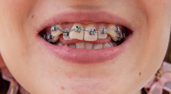 Braces Specialist: Your Path To Straighter Teeth