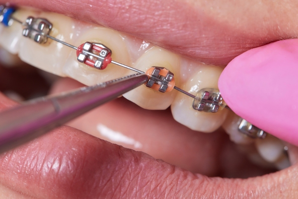 How Braces Can Fix Overcrowding And Spacing